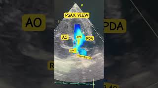PDA Patent Ductus Arteriosus Pediatric Echo ♥️ [upl. by Aratahs506]