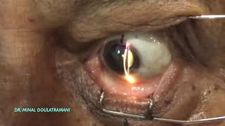 AIOC2021VT368Corneal Marking for Toric IOL [upl. by Nosemaj]