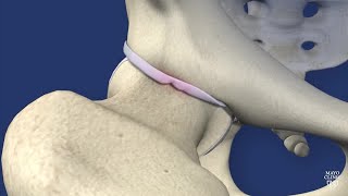 Mayo Clinic Orthopedics and Sports Medicine Hip impingement [upl. by Alad]