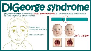 DiGeorge syndrome  22q11 2 deletion syndrome  Immunodeficiency [upl. by Malinde]