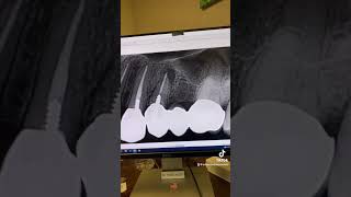 “Premolar root canals are so easy” [upl. by Portugal551]