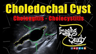 Choledochal Cyst with Cholangitis amp cholecystitis  Ultrasound  Case 272 [upl. by Corabelle]