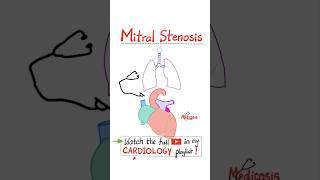 Mitral Stenosis MS  Valvular Heart Diseases VHD Part 2…anatomy mbbs cardio cardiology [upl. by Alyose618]