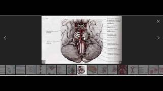 MRI discussion on Pontine Stroke [upl. by Nipsirc]