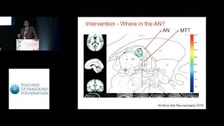 Vibhor Krishna  FUS thalamotomy for the prevention of secondary generalization in epilepsy 2018 [upl. by Oiretule]