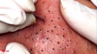 acne treatment how to remove blackheads on the face [upl. by Aynas]