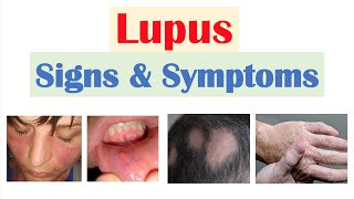 Lupus Signs amp Symptoms amp Why They Occur  Skin Joints Organ Systems [upl. by Kowatch]