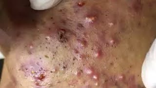 Inflammation Itching pustule and Toxic blood sucking of acne Part100 KD Acne Treatment [upl. by Wallis]