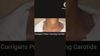 Corrigans Pulse  Dancing Carotids  Collapsing Pulse  water Hammer Pulse [upl. by Nnaeus150]