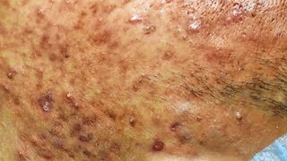 Acné kystiques et enlever les boutons sur le visage  cystic acne extraction [upl. by Ennayehc]