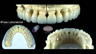 Reabilitação Oral Estética Facetas Coroas e Lentes de Contato Dental [upl. by Ethbinium]