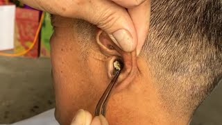 Removing ear blockage use manual tools [upl. by Thgiwd]