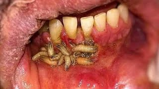 MYIASIS  Infection from flies  Management  Dr Zona khalid [upl. by Allare524]