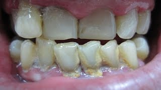 Home remedies for periodontitis pyorrhea  periodontal disease treatment [upl. by Toscano365]