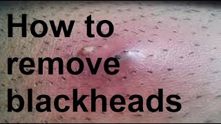 How to remove blackheads [upl. by Olotrab]