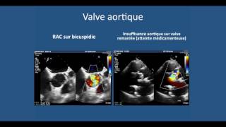 Echographie cardiaque transthoracique lessentiel a comprendre pour liECN [upl. by Olihs]