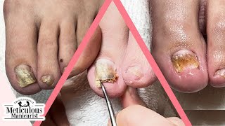 How to Fix Toenails that Change Shape and Color [upl. by Werdma628]