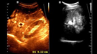 Sonographic Features of Gastric carcinoma  Limitations of Ultrasound  Complementary Imaging [upl. by Alludba]