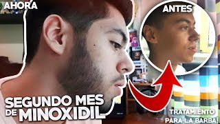 SEGUNDO MES USANDO MINOXIDIL  TRATAMIENTO PARA LA BARBA [upl. by Dominy564]