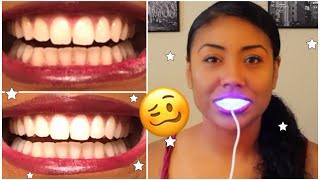 I Tried Smile Direct Teeth Whiten and THIS is What Happened 🥴 thorough review w pics [upl. by Eehtomit]