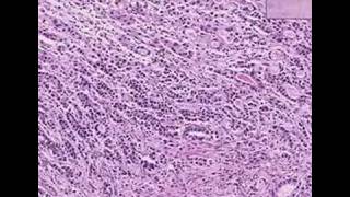 Histopathology StomachAdenocarcinoma [upl. by Piotr]