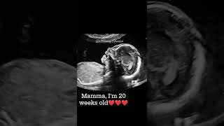 20 Weeks Pregnancy Ultrasound Scan [upl. by Cowey]