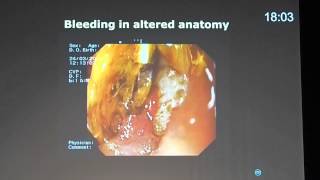 32 Device assisted enteroscopy utility in small bowel bleeding Prof Lars Aabakken [upl. by Uhej]