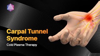 Managing Carpal tunnel syndrome using cold plasma therapy without drugs [upl. by Bandeen]