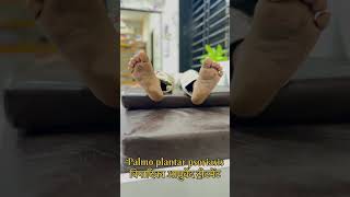 Palmo plantar psoriasis Ayurveda Treatment  Vipadika Ayurveda treatments palmoplanterpsorisis [upl. by Enilaf]