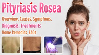 Pityriasis Rosea Overview Causes Signs and Symptoms Diagnosis Treatment Home Remedies and FAQs [upl. by Enitnatsnoc]