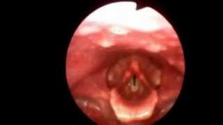 Flexible Video Stroboscopy Exam Kansas Voice Center [upl. by Hansiain337]