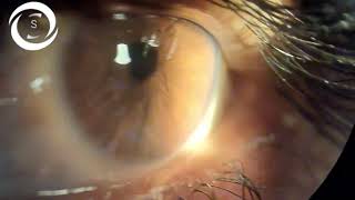 Ophthalmic Signs Syndrome [upl. by Cleveland653]