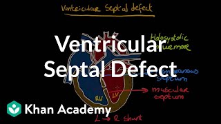 Ventricular septal defect  Circulatory System and Disease  NCLEXRN  Khan Academy [upl. by Anitnerolf]