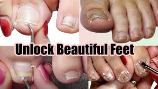 Transform Your Feet Mesmerizing Pedicure Compilation for Impacted Ingrown and Pincer Toenails [upl. by Davina786]