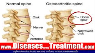 3 Osteophytes Bone Spur Causes Symptoms Diagnosis Treatment [upl. by Ronalda]