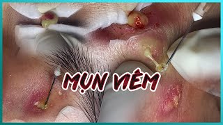 Big Cystic Acne Blackheads Extraction Blackheads amp Milia Whiteheads Removal Pimple Popping [upl. by Nolak]