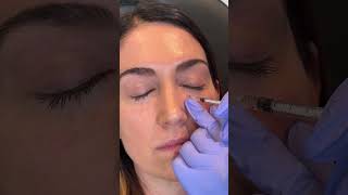 Under Eye Filler shorts undereyefiller [upl. by Eifos]