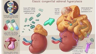 Congenital Adrenal Hyperplasia  Causes Clinical presentation Diagnosis and Treatment [upl. by Annaehr975]