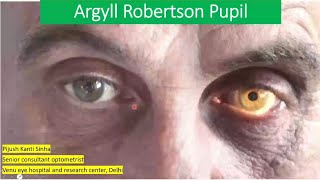 Pupil abnormality series lecture 4  Agryll robertson pupil VS adies tonic pupil [upl. by Hera]