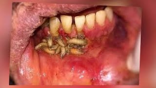 Oral maggots worms in the mouth  oral myiasis  treatment [upl. by Ellenij]