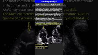 Cardiomyopathy 6 Arrhythmogenic Right Ventricle Cardiomyopathy [upl. by Frasco]