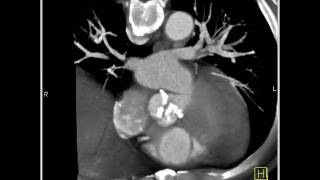 4D Imaging of the Aortic Valve Aortic valve 3 of 3 [upl. by Marlette]