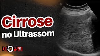 CIRROSE  APRENDA A RECONHECER NO ULTRASSOM I VOCÊ RADIOLOGISTA [upl. by Aneelahs561]