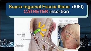 SupraInguinal Fascia Iliaca SIFI Catheter Insertion  the SUPRAINGUINAL approach [upl. by Eiraminot]