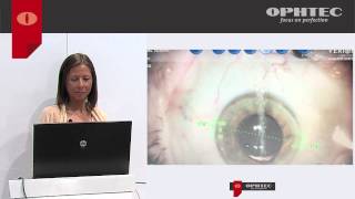 Visual Performance and Stability of a Monofocal Toric IOL Precizon by Ophtec [upl. by Rana]