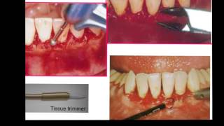 Gingivectomy amp Gingivoplasty [upl. by Ailelc]