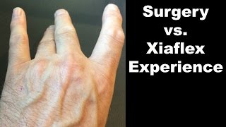 Dupuytrens Contracture Experience With Xiaflex Enzyme Injections vs Surgery Treatment [upl. by Ilek405]