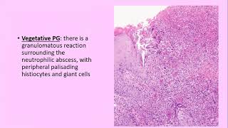 Lecture99 Neutrophilic Dermatoses Pyoderma Gangrenosum amp Sweets syndrome PartI Rooks Ch 49 [upl. by Rianna929]