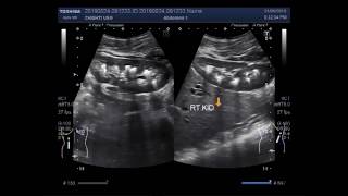 Ultrasound Video showing bilateral Medullary nephrocalcinosis and renal calculi [upl. by Zakaria]