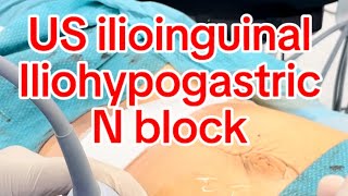 US guided Ilioinguinal iliohypogastric ns block [upl. by Hankins]